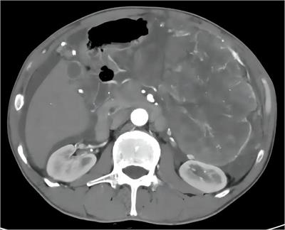 Unexpected reaction of “wild-type” gastrointestinal stromal tumor to imatinib: case report and literature review